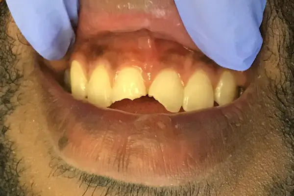 Cracked Tooth Symptoms: 6 Common Causes and What to Do
