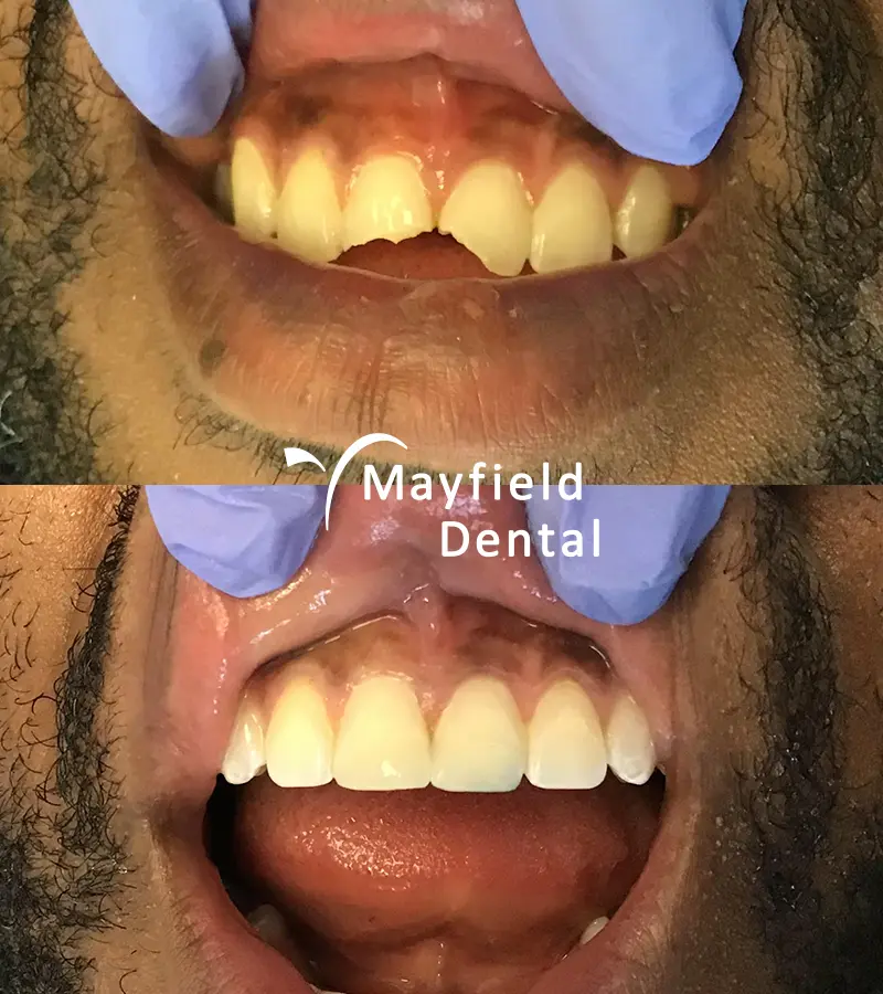 before and after composite bonding on an ethnic man's cracked teeth at Mayfield Dental