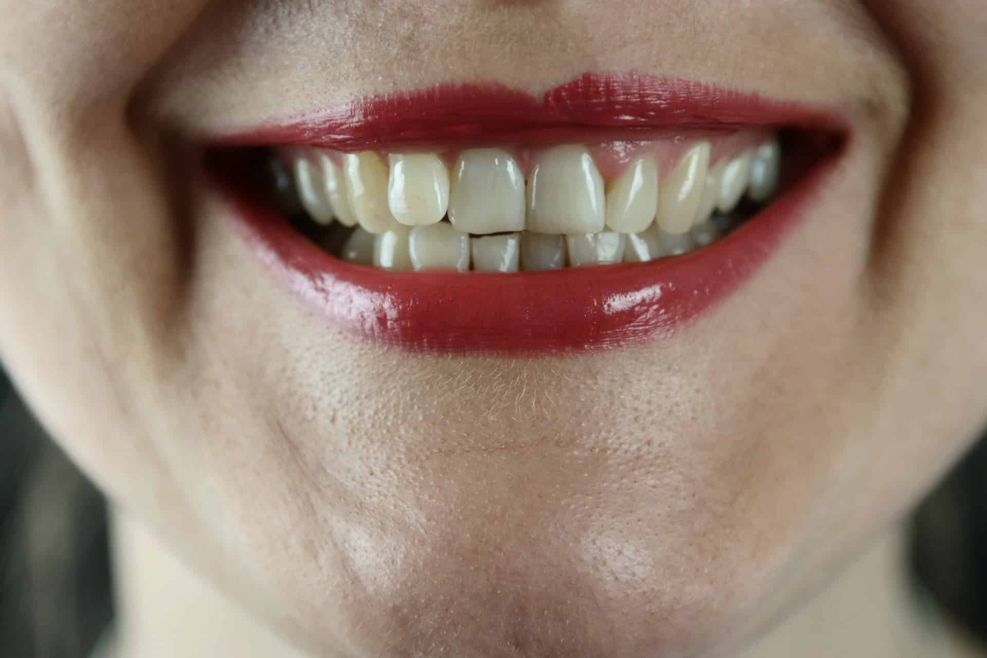 What is the cause of bleeding gums?