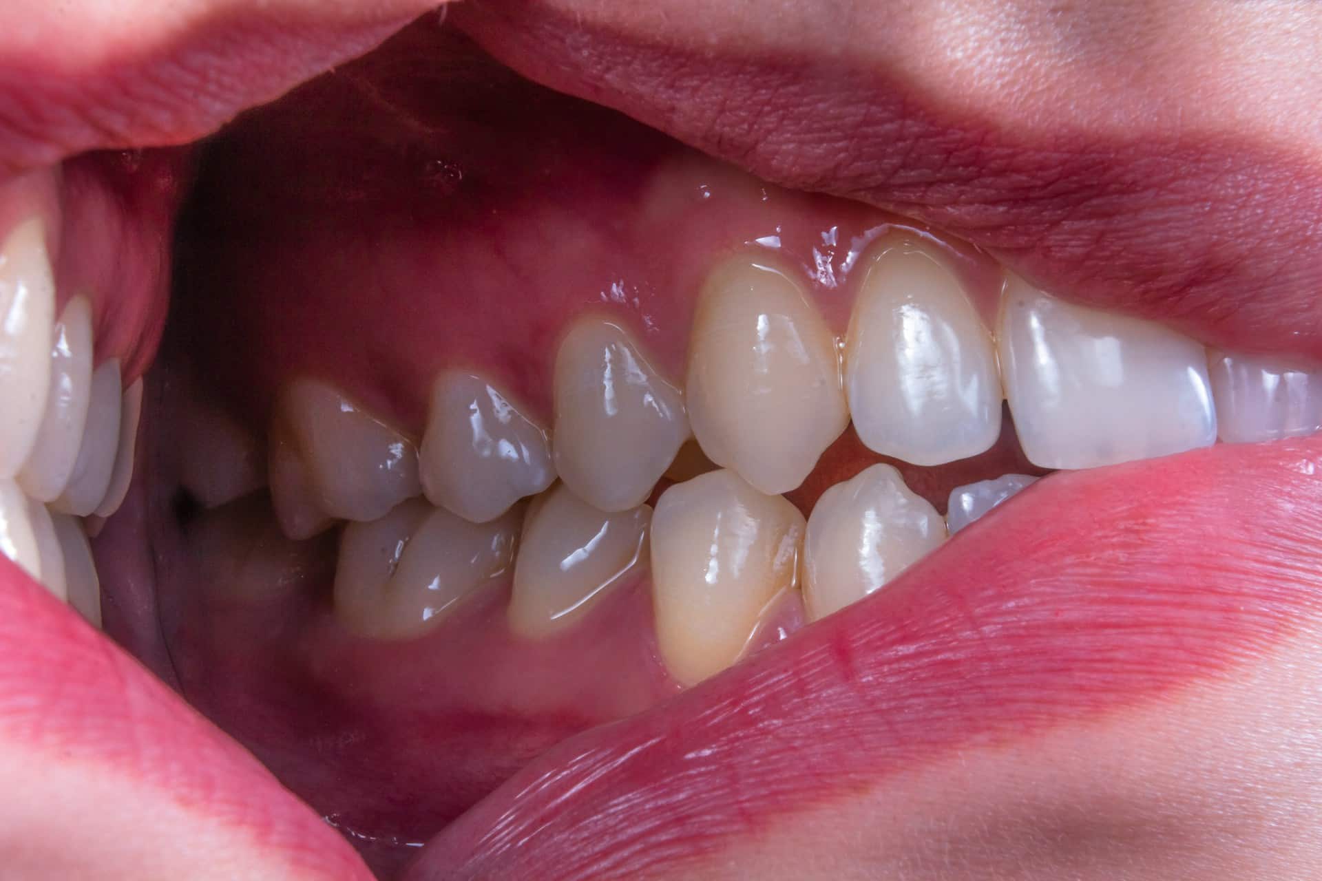 What causes tooth sensitivity and how to prevent it