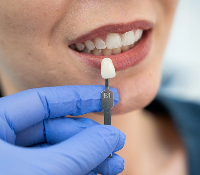 teeth whitening