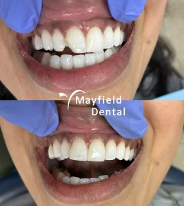 composite bonding croydon patient before and after