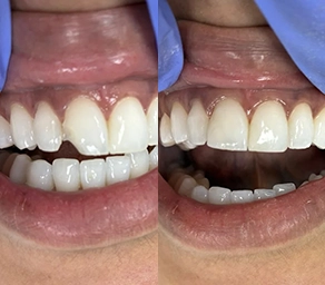 Composite bonding before and after