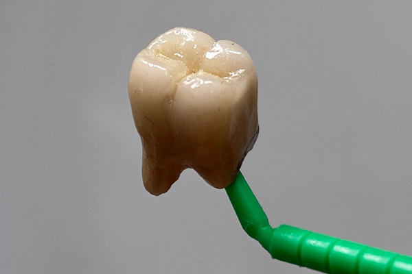 Do I Really Need a Crown After a Root Canal?
