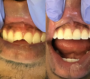 dental emergency service before and after cracked front teeth